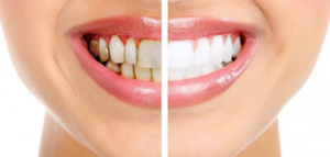 What Your Dentist Can Learn From The Pattern Of Tooth Stains