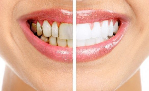 What Your Dentist Can Learn From The Pattern Of Tooth Stains
